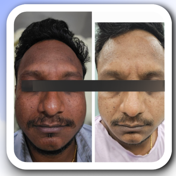 Acne Treatment - Before & After