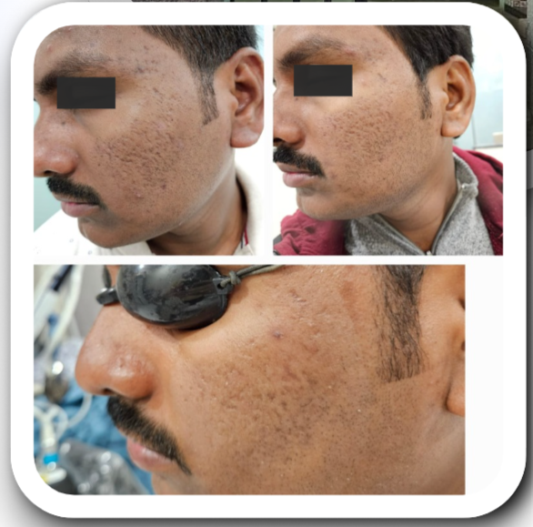 Pigmentation Treatment - Before & After