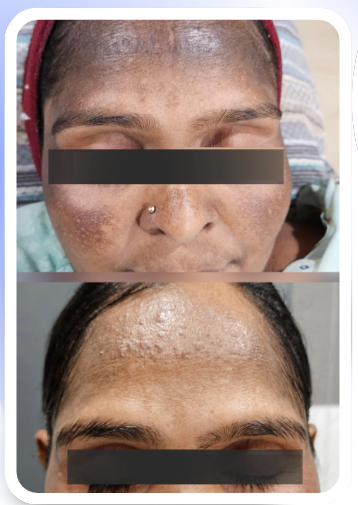 Hair Loss Treatment - Before & After