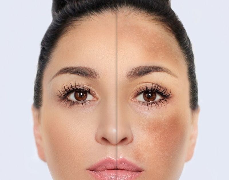 Melasma Treatment
