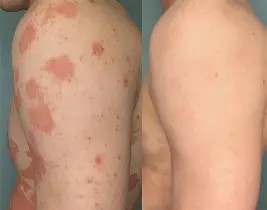 Psoriasis Treatment