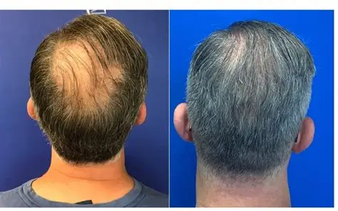 Hair Loss Treatment
